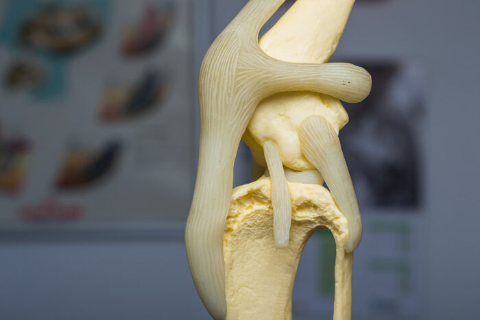 Tibial Tuberosity Advancement Using Xgen (forkless) Plate